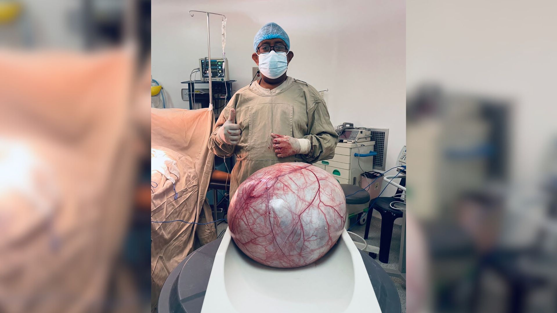11 horas tardaron médicos extrayendo tumor de 12 kilos a mujer wayuú en Uribia