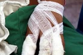 Mujer de 58 años resultó lesionada con pólvora en El Molino