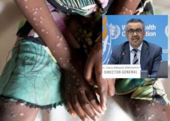 OMS declara la viruela del mono como una emergencia mundial de salud