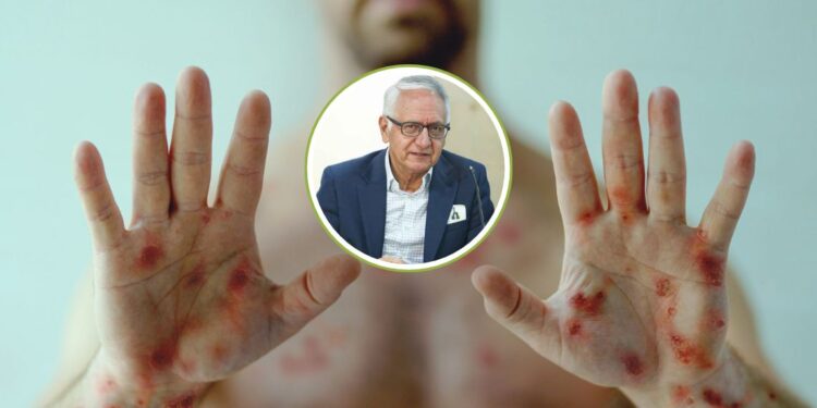 Colombia refuerza vigilancia ante declaratoria de Emergencia Internacional por variante Mpox clado I