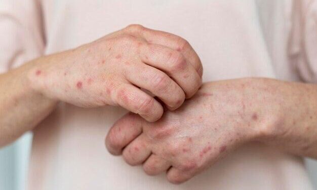 Detectan casos de lepra en el Magdalena: Secretaría de Salud activó protocolos de prevención