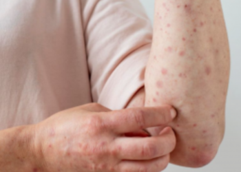 Alarma en Europa y Asia Central por el mayor brote de sarampión en más de 25 años