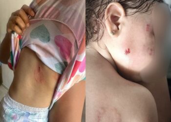 Madre denuncia que su hija de 1 año y 5 meses habría sido mordida en un CDI en Manaure