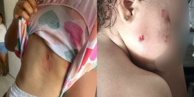 Madre denuncia que su hija de 1 año y 5 meses habría sido mordida en un CDI en Manaure