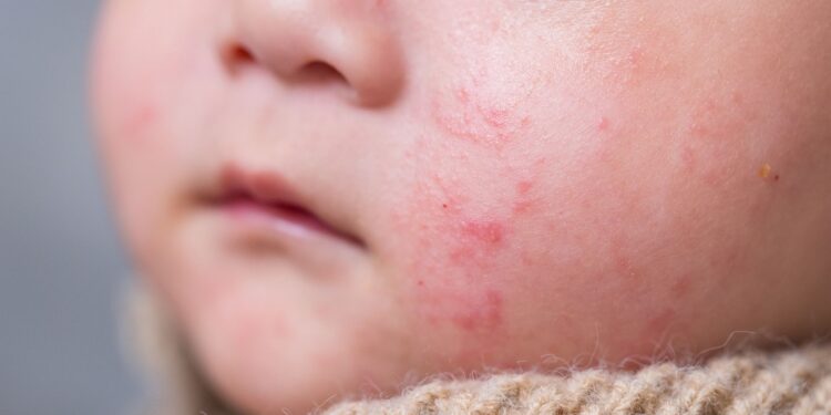 Autoridades de salud en Cartagena activan alerta por brote viral en población infantil