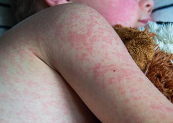 Colombia activa alerta sanitaria tras detección de casos importados de sarampión